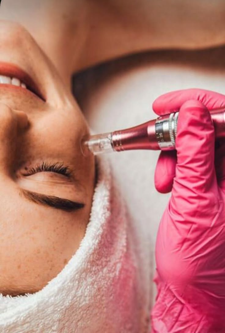 Microneedling Avanzado